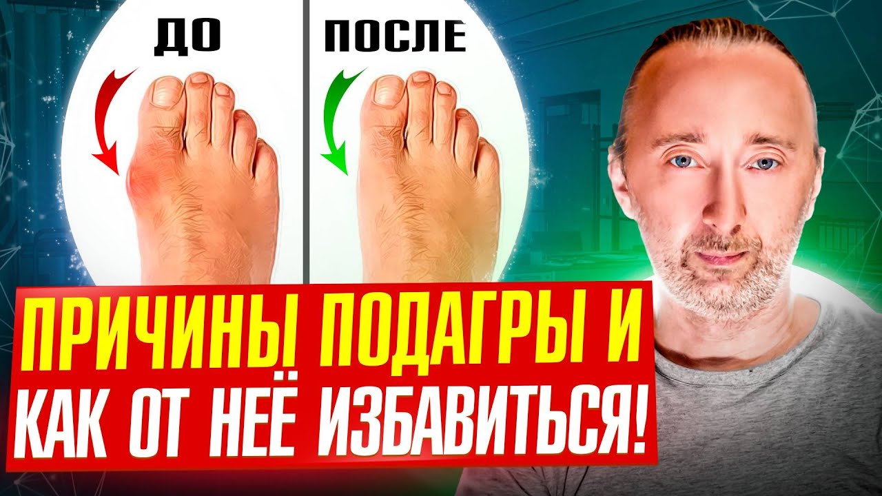 Секрет подагры раскрыт: причины подагры и её лечение! Что есть и пить при подагре?