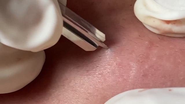 Make your Acne Treatment Huong Da Nang | 453# acne 2022